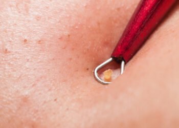 Atskleidžiama, kokios spuogų rūšies niekada nereikėtų spausti