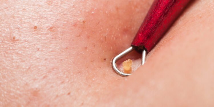 Atskleidžiama, kokios spuogų rūšies niekada nereikėtų spausti