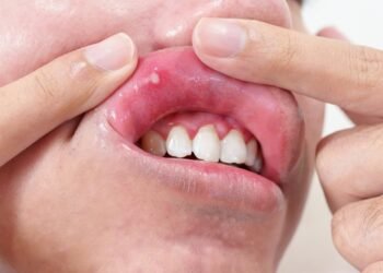 Kaip atpažinti, kada afta rodo rimtesnę problemą