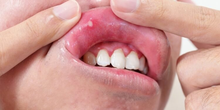 Kaip atpažinti, kada afta rodo rimtesnę problemą