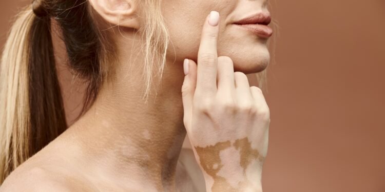 Vitiligo: suprasti šią autoimuninę ligą