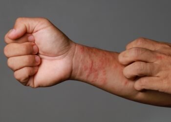 Atopinis dermatitas: dažniausia egzemos forma ir kaip ją atpažinti