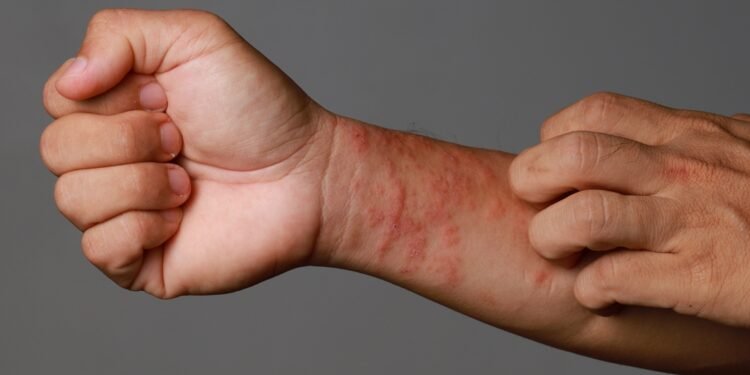 Atopinis dermatitas: dažniausia egzemos forma ir kaip ją atpažinti