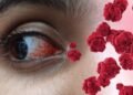Alergija ar konjunktyvitas? Kaip atskirti šias būkles