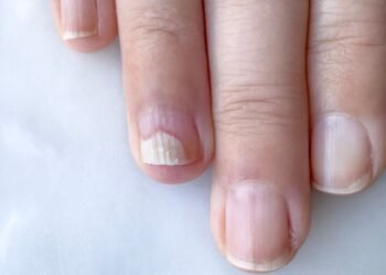 Ką reiškia baltos dėmelės ant jūsų nagų