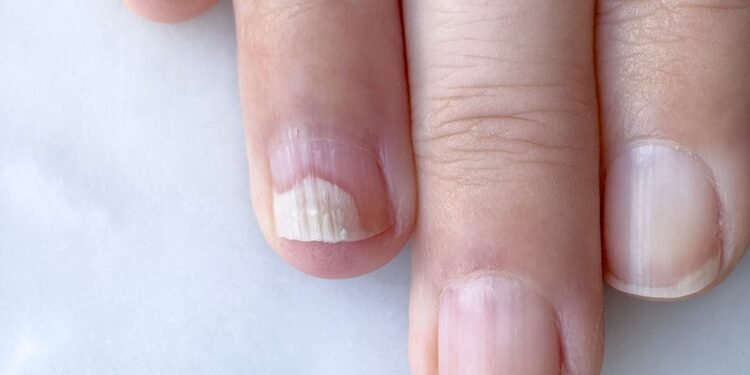 Ką reiškia baltos dėmelės ant jūsų nagų