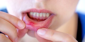 Aftų (burnos gleivinių) skausmas